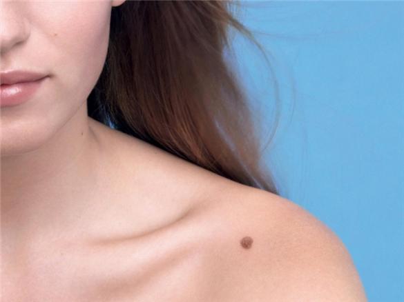 Xem vận mệnh của mình qua vết bớt